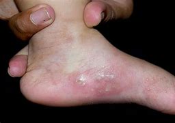 Image result for Scabies Baby