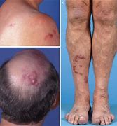 Image result for Lymphoma Skin Lesions