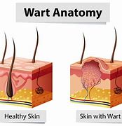 Image result for Pics of Warts On Face