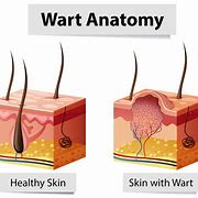 Image result for Blood Warts Skin