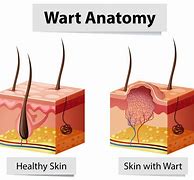 Image result for Skin Warts On Hands