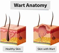 Image result for Wart On Chin