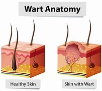 Image result for Common Warts On Face