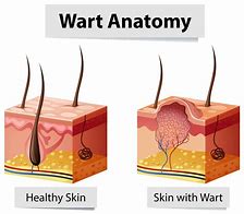 Image result for Common Warts On Fingers