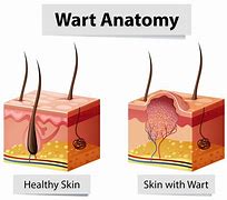 Image result for Common Wart Falling Off