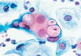 Image result for Chlamydia Lesions