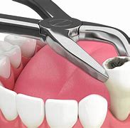 Image result for Tooth Extraction Bone Showing