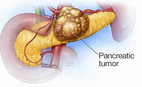 Image result for 2 Cm Tumor On Pancreas