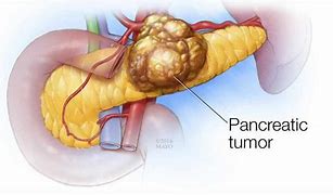 Image result for Pancreatic Cancer Tumor Size