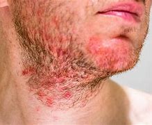 Image result for Folliculitis Anatomy