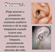 Image result for otorrea