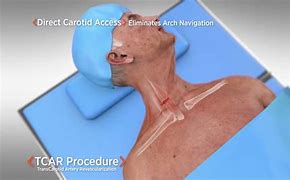 Image result for Carotid Endarterectomy Surgery