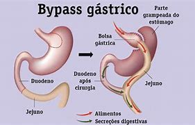 Image result for Bypass Gastrico
