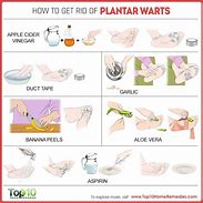 Image result for Get Rid of Planters Wart On Foot