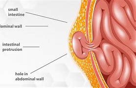 Image result for What Does a 5 Cm Hernia Look Like