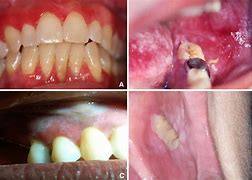 Image result for Gingival Erythema