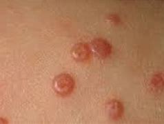 Image result for Popping Molluscum