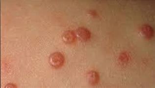 Image result for Molluscum Contagiosum Removal