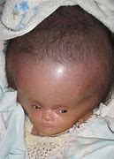 Image result for Baby Big Head Syndrome