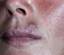 Image result for Tertiary Syphilis