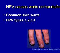 Image result for HPV Foot