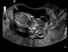 Image result for Acrania Ultrasound