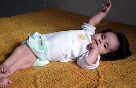 Image result for Babies Born with Sirenomelia