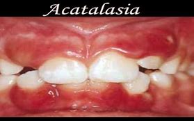Image result for acatal�ctico