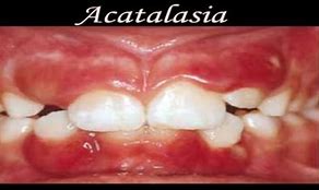 Image result for acatal�ctick
