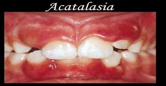 Image result for acatal�ftico