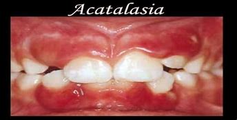 Image result for acatal�ctido