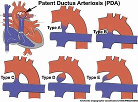 Image result for PDA Medical Condition