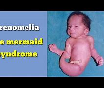 Image result for Sirenomelia Facts