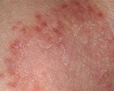 Image result for Fungus On Human Skin