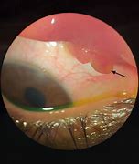Image result for Conjunctival Granuloma Eye