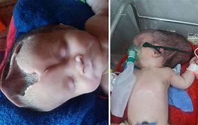 Image result for Babies with Anencephaly