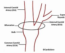 Image result for Bifurcation of Carotid Artery