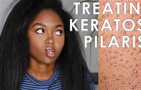 Image result for Keratosis Pilaris On Face Treatment