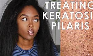 Image result for Keratosis Pilaris Removal