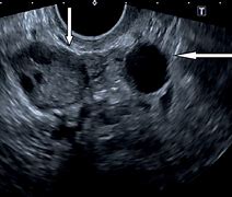 Image result for Cyst On Ovary Ultrasound