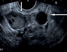 Image result for Ultrasound Cyst Adjacent to Ovary