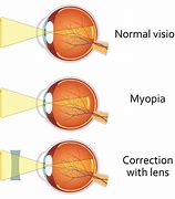 Image result for myopic