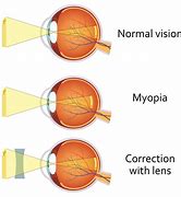 Image result for Myopia Vision