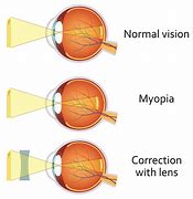Image result for Myopia Vision Example