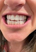 Image result for Byte Teeth