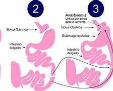 Image result for Quintuple Bypass