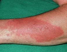 Image result for Small 2nd Degree Burn
