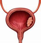 Image result for Bladder Cancer Tumor Size