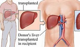 Image result for https://healthyturkiye.com/liver-transplant-in-turkey