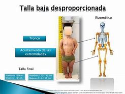 Image result for acondroplaxia